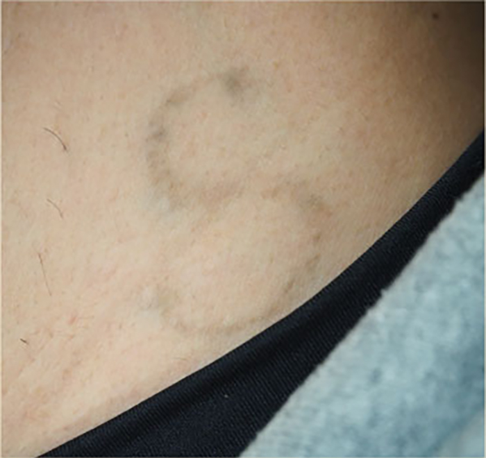 症例3　刺青（タトゥー）除去（レーザー） 30歳男性 治療2回後