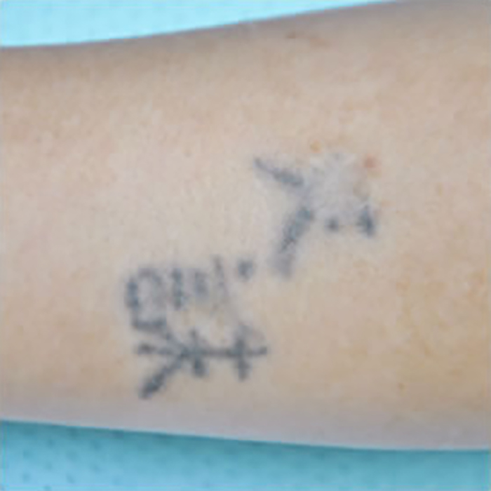 症例5　刺青（タトゥー）除去（切縫法） 27歳女性 手術前