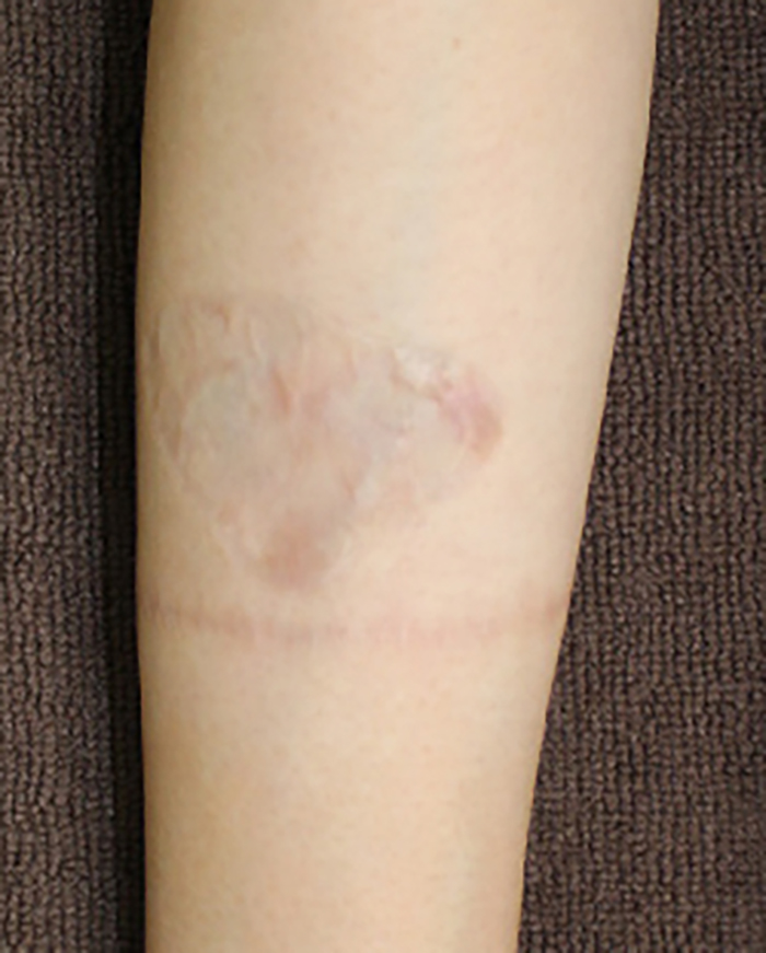 症例12　刺青（タトゥー）除去（植皮法） 20歳女性 手術後